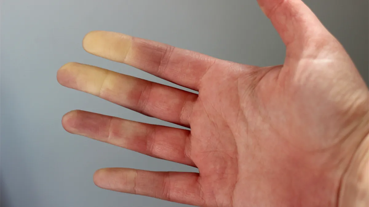 Iarna: De ce se albesc degetele? Este o problemă de sănătate?