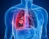 Un medicament-speranță pentru pacienții diagnosticați cu o formă de cancer pulmonar agresiv