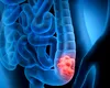 Noi reguli pentru depistarea precoce a cancerului de colon: Ministerul Sănătății propune o nouă metodologie