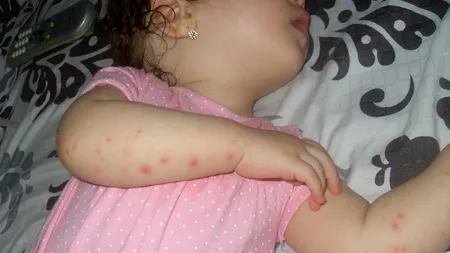 Boala mână-picior-gură, cea mai contagioasă dintre bolile vacanței!