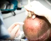 Tragedie după un transplant de păr în Turcia: un tânăr de 38 de ani a murit la scurt timp după intervenție