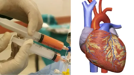 Injecția de celule stem, noua armă împotriva insuficienței cardiace