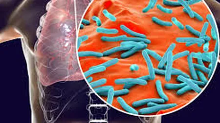 De ce tuberculoza e pe cale să explodeze la nivel global