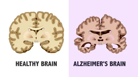 Tratament revoluționar pentru Alzheimer, aprobat și în UE