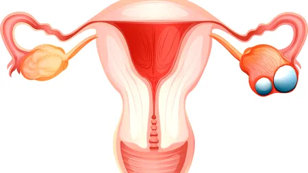 Cancerul ovarian, în creștere! Atenție la simptome!