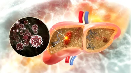 Premieră în România: Hepatocarciom tratat cu microsfere radioactive
