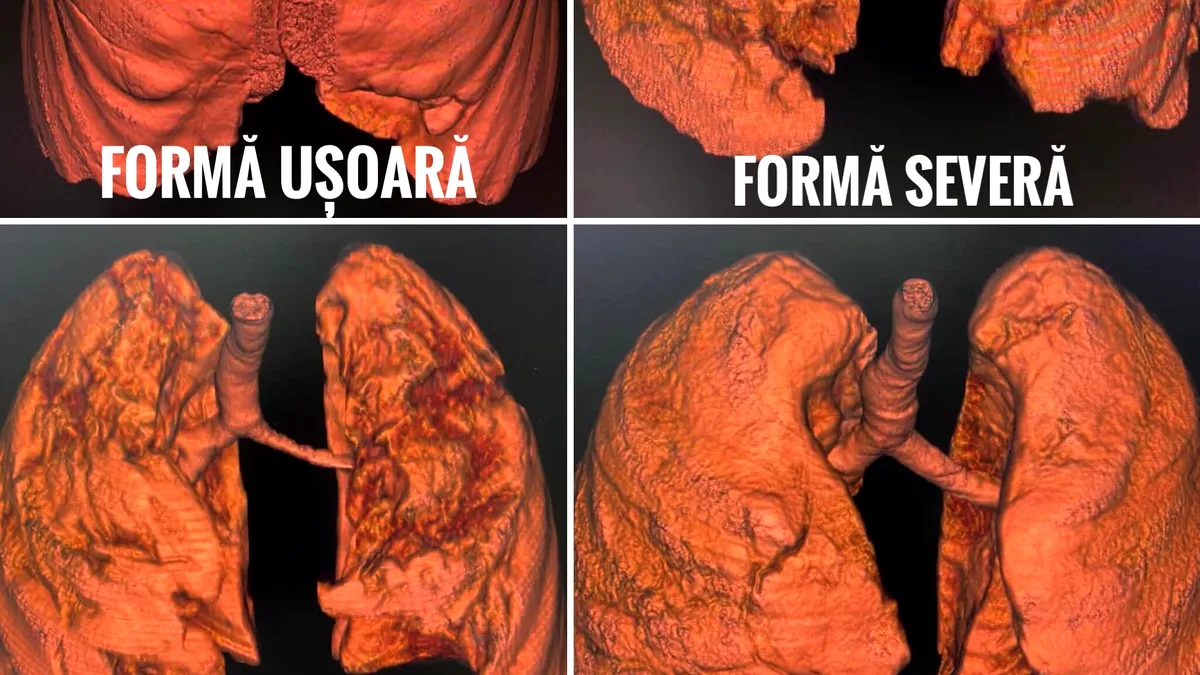 Cum arată plămânii unor pacienți nevaccinați bolnavi de COVID-19