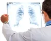 Un nou factor de risc al cancerului pulmonar!