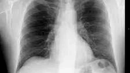 Cancerul pulmonar, prezis cu ajutorul unui program informatic