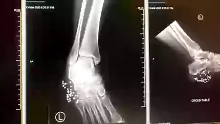Piciorul unei femei, salvat de la amputare de papucii pe care îi purta. Ce s-a întâmplat?