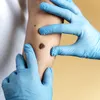 Detectarea cancerului de piele în 30 de secunde