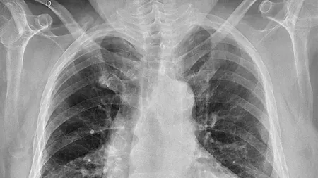 Detectarea tuberculozei simplu, rapid și ieftin prin analizarea aerului expirat de pacient
