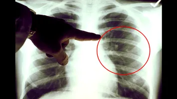Un test de urină care detectează precoce cancerul pulmonar