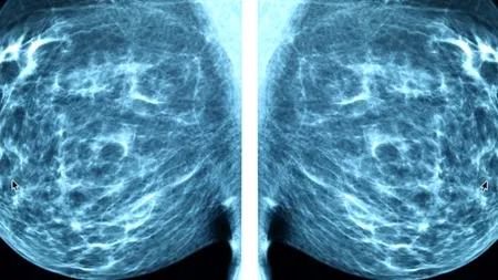 Progres uluitor: IA e capabilă să ”prezică” apariția cancerului la sân!