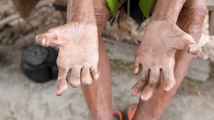 Ministerul Sănătății confirmă primul caz de lepră după 44 de ani. Alte trei persoane, sub monitorizare