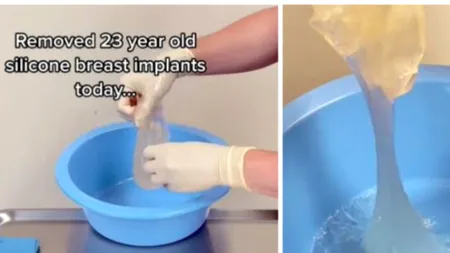 Cum arată niște silicoane vechi de 23 de ani. Doctorul s-a șocat!