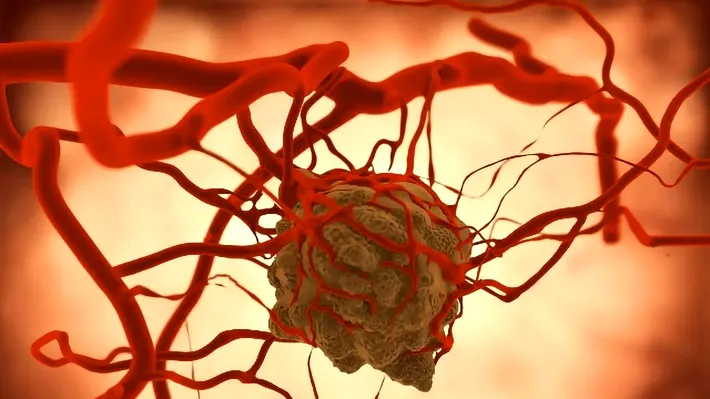 Apel în sprijinul pacienților cu neurofibromatoză de tip 1:  diagnostic fără întârzieri, tratament fără întreruperi!