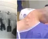 Un tânăr de 23 de ani a dezvoltat un sindrom rar și grav al gâtului după ani de dependență de droguri