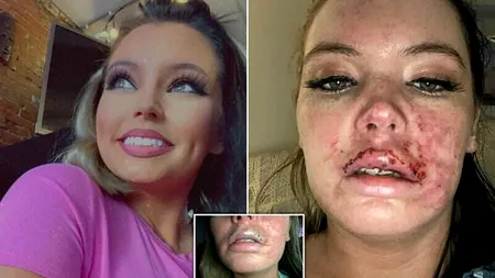 O femeie a fost cât pe ce să își piardă buza superioară după o injecție cu botox FOTO