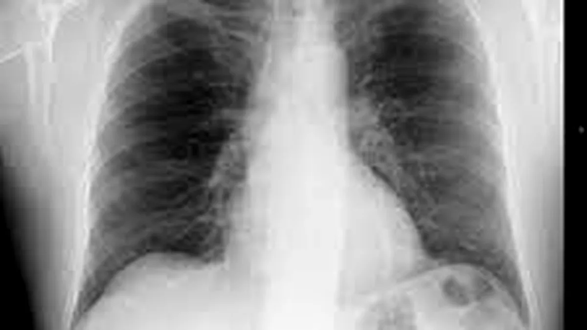 Cancerul pulmonar, prezis cu ajutorul unui program informatic