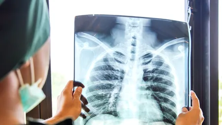Screening TB pentru 75.001 persoane din comunităţi defavorizate