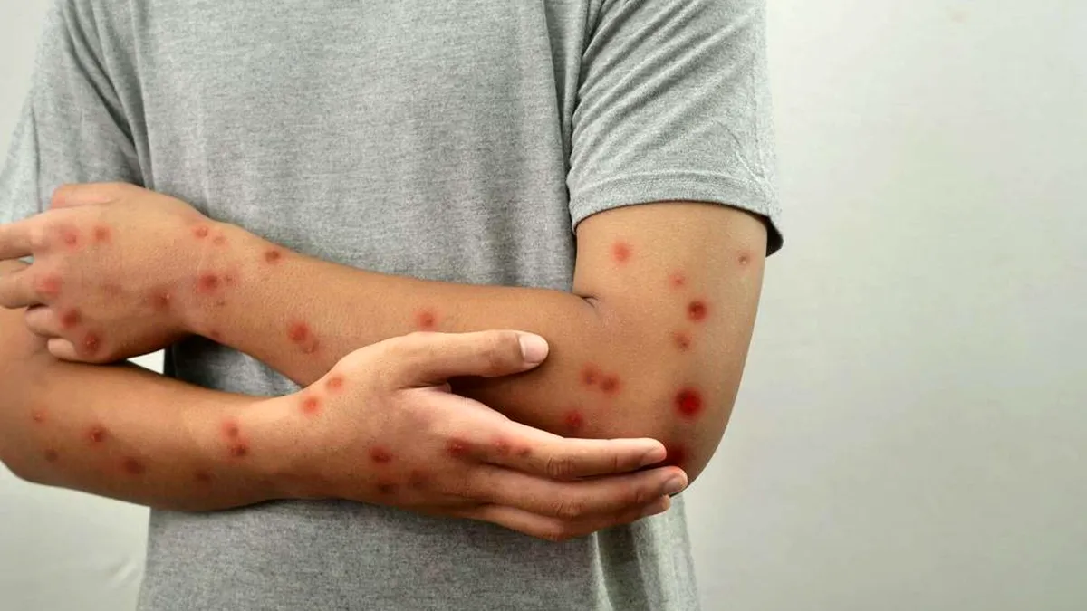Un prim caz al noii variante de mpox, în Franța