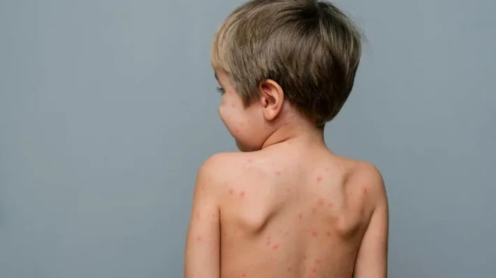 Boală extrem de contagioasă, la un pas de România. Țara declară stare de alertă