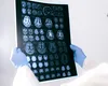 O descoperire de la UMF Craiova deschide noi perspective în tratamentul Alzheimerului