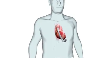 Cel mai important pas în salvarea pacienților cu insuficiență cardiacă: prima pompă cardiacă. Premieră mondială