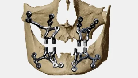 Modelarea 3D, implanturile personalizate și perspectivele lor viitoare în chirurgia craniofacială