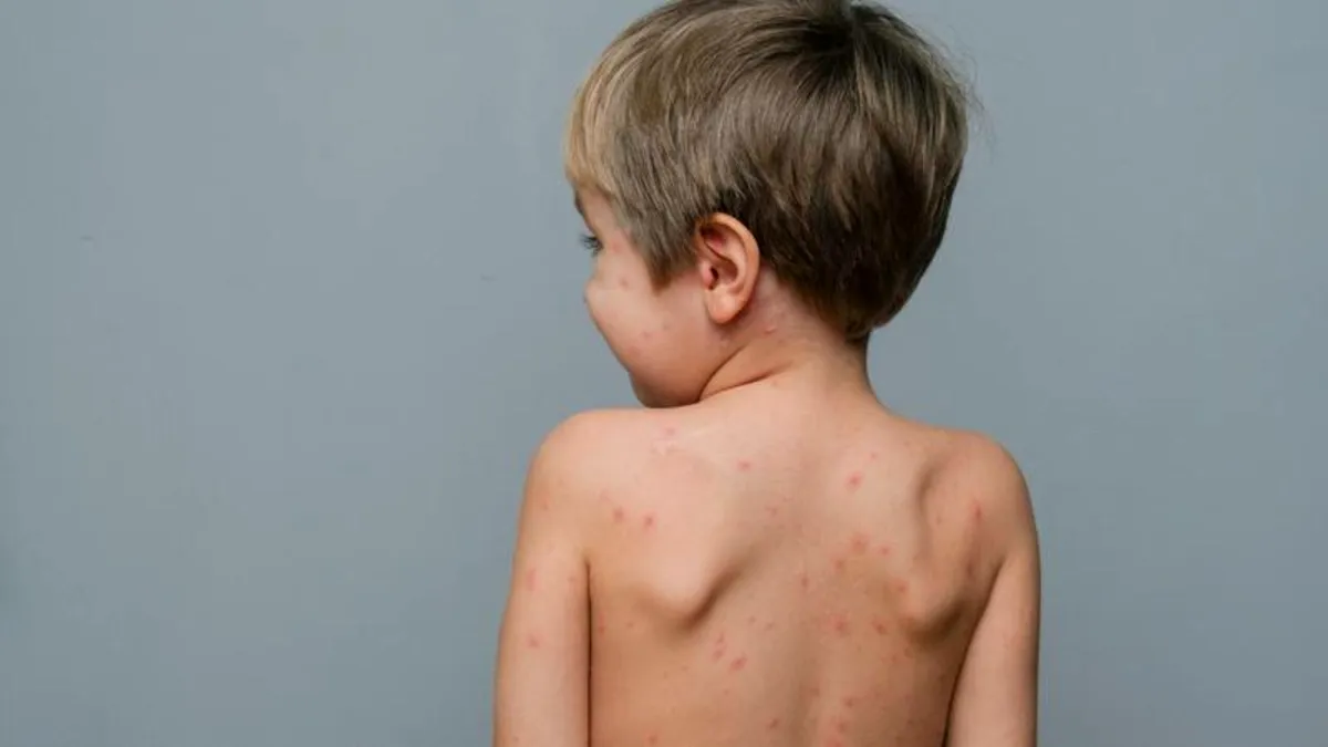 Boală extrem de contagioasă, la un pas de România. Țara declară stare de alertă