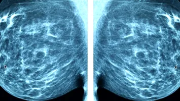 Progres uluitor: IA e capabilă să ”prezică” apariția cancerului la sân!