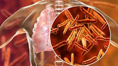 Premieră: Un nou tratament mai eficient pentru tuberculoza rezistentă la medicamente