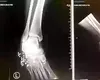 Piciorul unei femei, salvat de la amputare de papucii pe care îi purta. Ce s-a întâmplat?