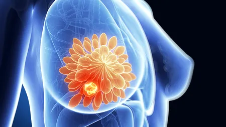 Depistarea cancerului de sân cu un dispozitiv implantat în sutien