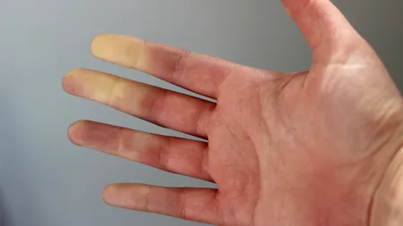 Iarna: De ce se albesc degetele? Este o problemă de sănătate?