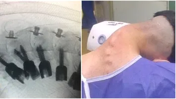 Un tânăr de 23 de ani a dezvoltat un sindrom rar și grav al gâtului după ani de dependență de droguri