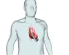 Cel mai important pas în salvarea pacienților cu insuficiență cardiacă: prima pompă cardiacă. Premieră mondială