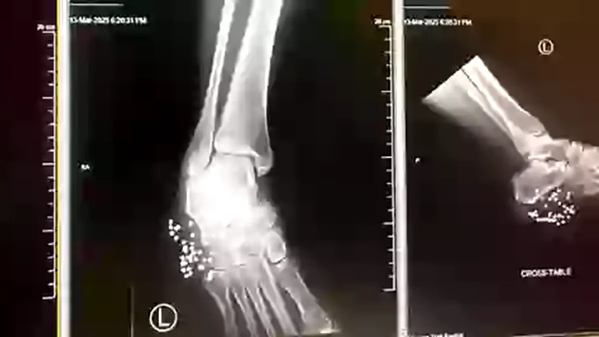 Piciorul unei femei, salvat de la amputare de papucii pe care îi purta. Ce s-a întâmplat?