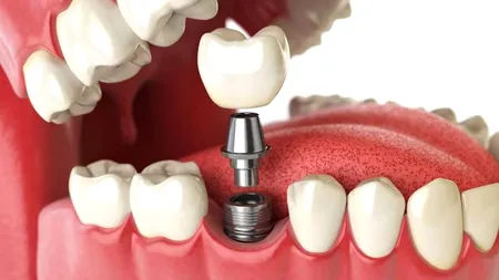 4 Lucruri esențiale pe care trebuie să le cunoști despre implanturile dentare