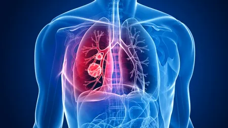 <strong>Tratament care reduce la jumătate riscul de deces în cancerul pulmonar</strong>