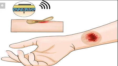 Pansament electronic care accelerează cicatrizarea rănilor