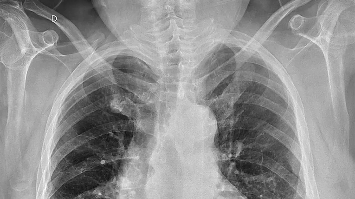 Transplant dublu de plămâni, o soluție în unele cazuri de cancer pulmonar