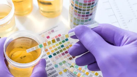 Cancerul prostatei: în curând, detectarea printr-un test de urină!?