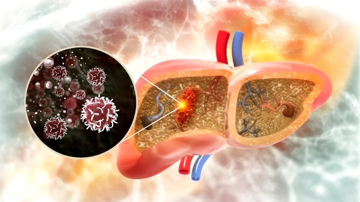 Premieră în România: Hepatocarciom tratat cu microsfere radioactive