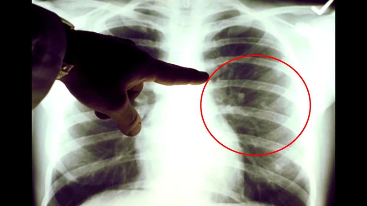 Un test de urină care detectează precoce cancerul pulmonar