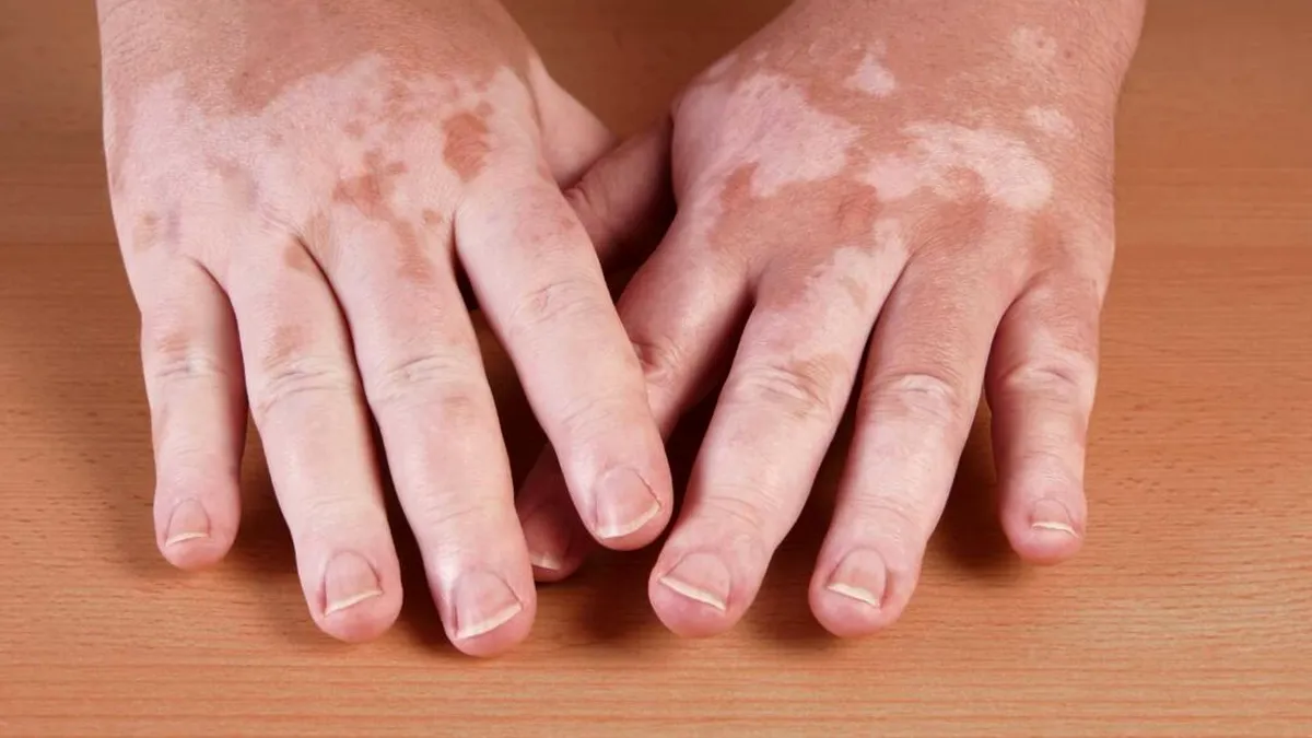 EMA a da undă verde unui prim tratament contra vitiligo