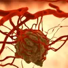 Apel în sprijinul pacienților cu neurofibromatoză de tip 1:  diagnostic fără întârzieri, tratament fără întreruperi!