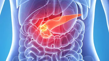 Cancerul pancreatic: două tratamente combinate și un vaccin oferă rezultate uimitoare