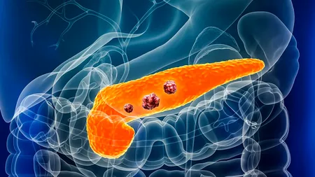 Un simptom relevant pentru cancerul pancreatic